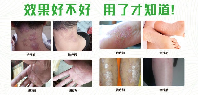 菠萝蜜视频污APP真菌清喷剂